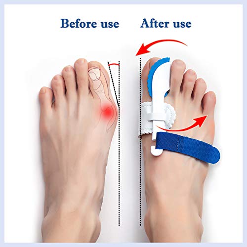 Bunion Corrector Brace for Pain Relief, Hallux Valgus Corrector & Big Toe Joint Support – Adjustable Night Splint for Men and Women, Comfortable Bunion Valgus Protective Cover (2Pcs)