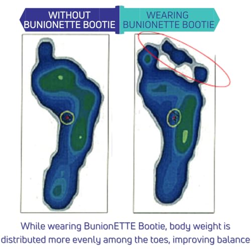 BunionETTE Bootie Tailor Bunion Corrector for Women & Men, Toe Spreader for Tailor Bunion, Bunionette Corrector, Bunionette Relief Socks, Bunionette Protector, Spacer Splint - Small, Right