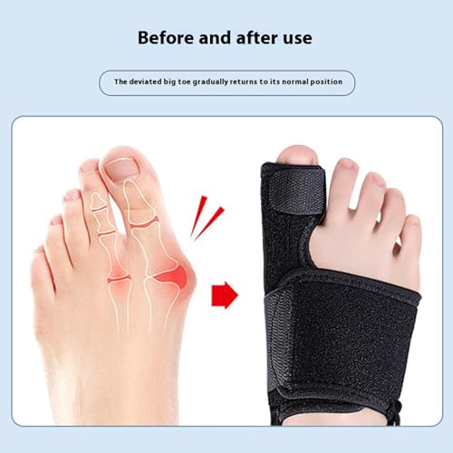 Recovist Bunion Brace, 2025 New Recovist Bunion Brace For Women, Adjustable Orthopedic Splint For Hallux Valgus Correction, Advanced Alignment Technology, Just 20 Minutes A Day (Right)