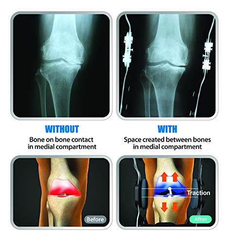 DDS, Inc. OA Pro Decompression Knee Braces - Arthritis Knee Support for Degeneration, Meniscus Tear, Bone-on-Bone Pressure Relief - Dual Unloading for Medial & Lateral Stability (Medium)