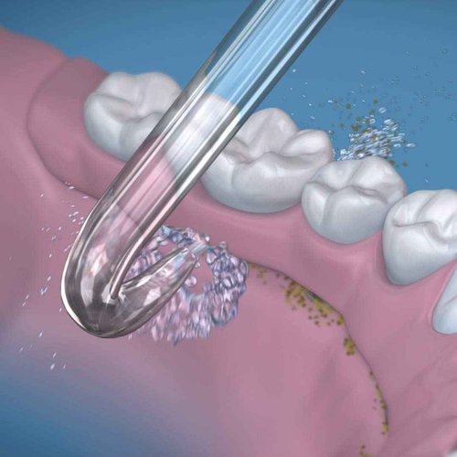 Waterpik Water Flosser for Teeth, Portable Electric Compact for Travel and Home - Nano Plus, WP-320 & DT-100E Implant Denture Replacement Tips Water Flosser Tip Replacement, Clear, 2 Count