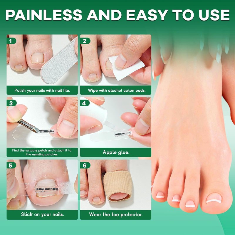 Titanium Alloy Ingrown Toenail Corrector New Version Ingrown Toenail Removal Tool Kit, Designed for Curved Nail Repair Big Toe Ingrown Toenail