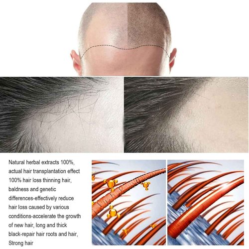 Thicair Hair Regrowth System - Advanced Hair Growth Treatment with Copper Peptides & Collagen, Knotweed and Ginseng Root Extract, Hydrating & Fuller Hair Kit for Fine or Thinning-Looking Hair (1)