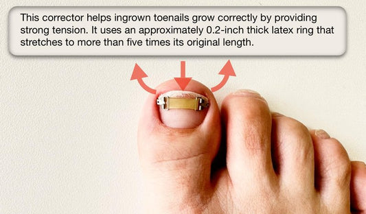 Ingrown Toenail Treatment & Corrector with Latex Elasticity - Curved Toenail Straightener | Effective Daily Solution for Ingrown Toenail Pain & Growth Correction [M/0.75inches/18-20mm]
