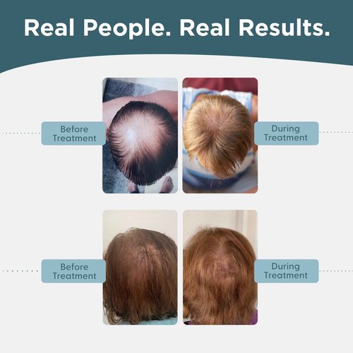 Shapiro MD Hair Growth Experts Minoxidil 5% Topical Solution for Men's Hair Growth, Serum Promotes Hair Regrowth by Reactivating Hair Follicles - 4 Month