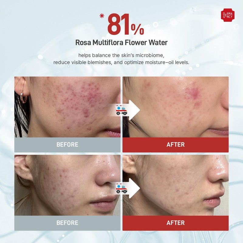 DERMAGENCY Zeroca 81 Cream | Korean Acne Cream for Sensitive & Oily Skin | Lightweight, Non-Greasy, Calming Hydration | Oil Control, Pore Refining, Cica | Fragrance-Free | K-beauty 2.02 Fl.Oz / 60ml