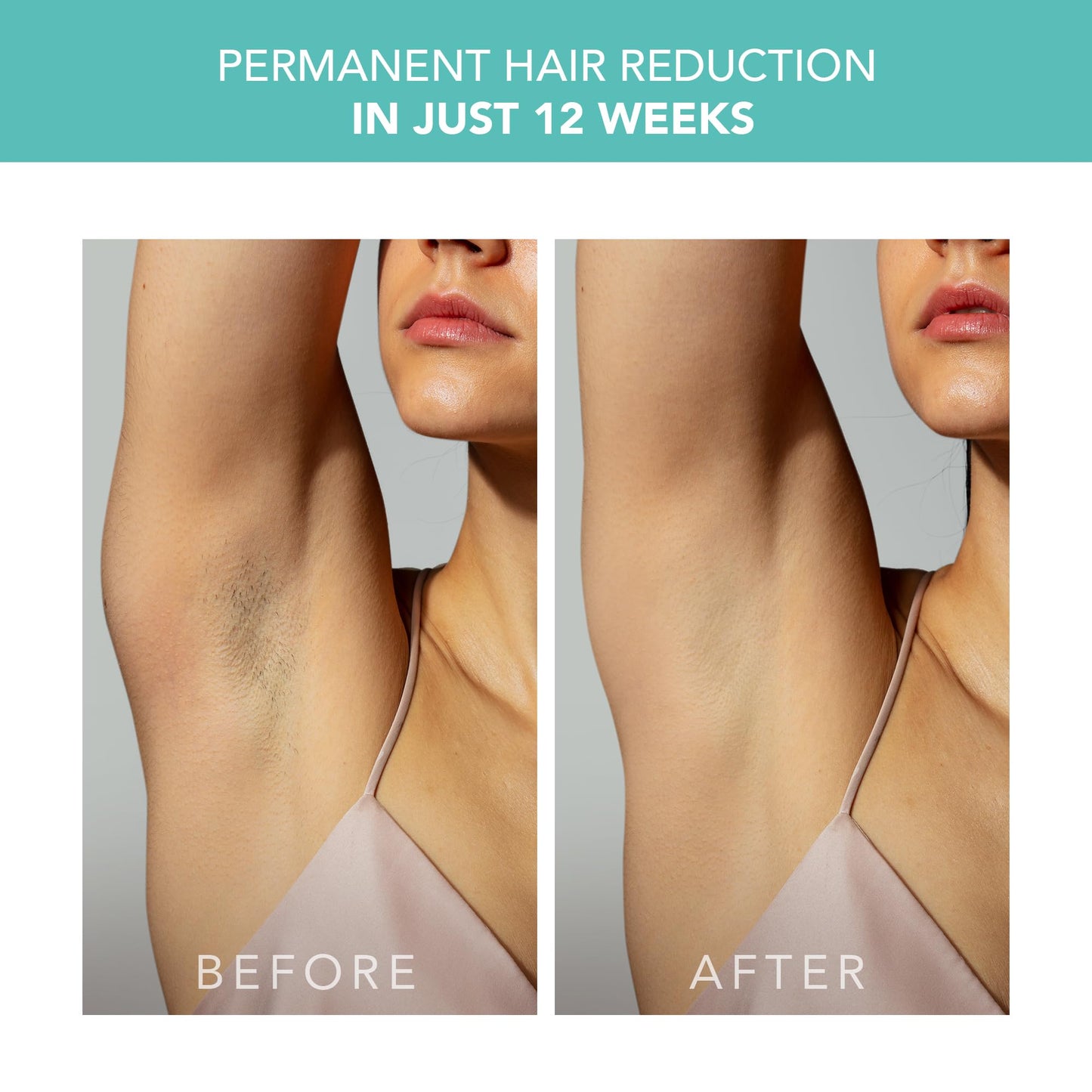 FOREO Peach 2 IPL Hair Removal Device – Quick & Gentle Hair Reduction – for Full Body & Face – Skin Cooling System – Silicone Shield – Customizable