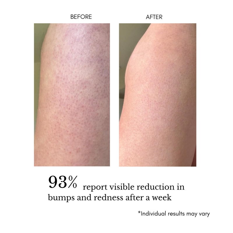 klarifyScience KP Treatment Serum - Triple Acid Complex (AHA + BHA + PHA) for Keratosis Pilaris | Gentle Daily Face and Body Serum for Rough Bumpy Skin, Strawberry Legs & Ingrown Hairs | 4 fl oz