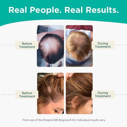 Shapiro MD Hair Growth Experts Thinning Hair Shampoo, Conditioner, Leave-in Foam Bundle for Thicker, Fuller Hair - Unisex-Adults