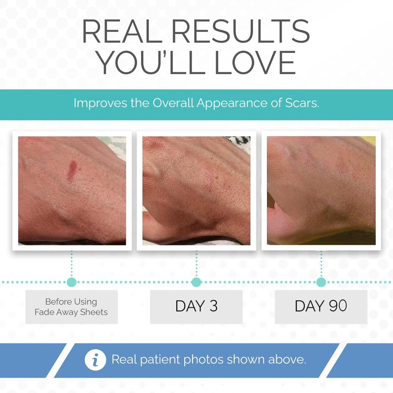 Clinically Proven Silicone Scar Sheets – Medical Grade Tape for Surgery, C-Section, Keloids & Tummy Tuck Scars
