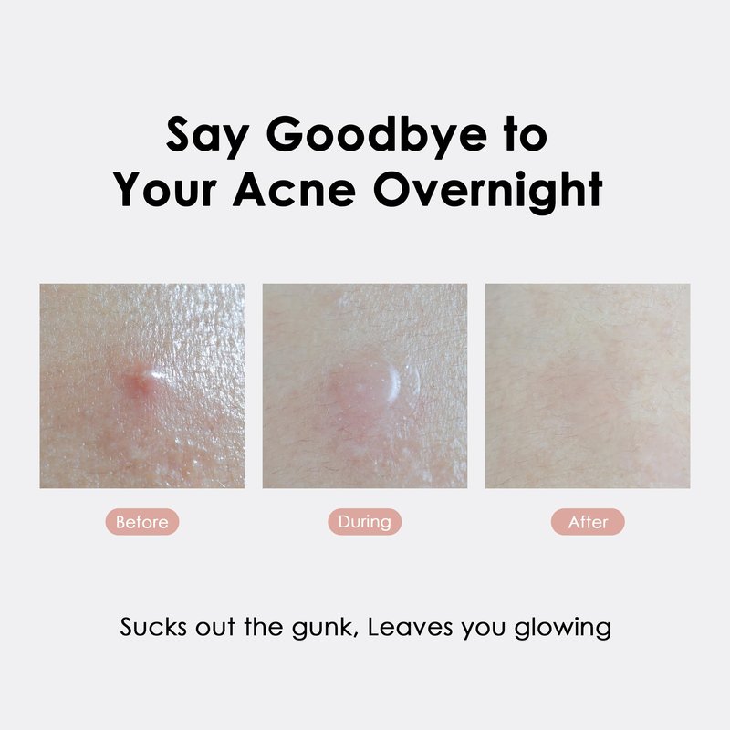 glowiest ASAP Active Spot Alleviating Patch 39 Patches [Daytime] 10mm (1 * 15ea) & 12mm (2 * 12ea) | Premium Hydrocolloid Dressing | Simple & Easy Active Treatment (Pack of 2)