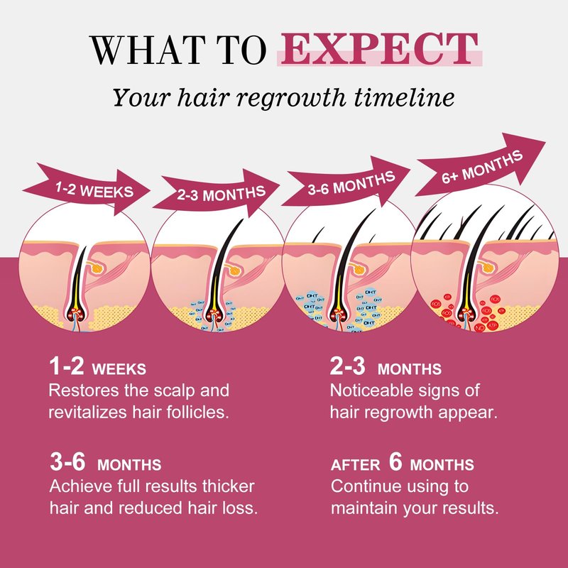 5% Minoxidil for Women Hair Regrowth Spray, hers hair regrowth treatment Infused with Biotin, Extra Strength Treatment to Combat Hair Loss and Thinning, 6 Bottles（100 Ml)