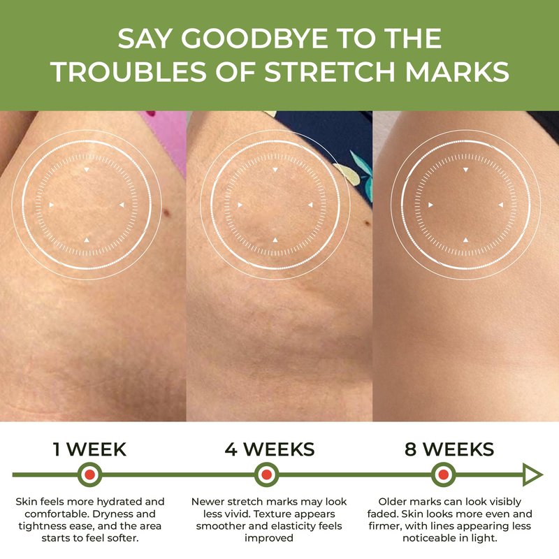 Abera Ovela Maternity Stretch Mark Cream for Pregnancy and Weight Fluctuations, Stretch Mark Treatment Pregnancy Must Haves, Deep Stretch Mark Removal, 1.69 fl oz