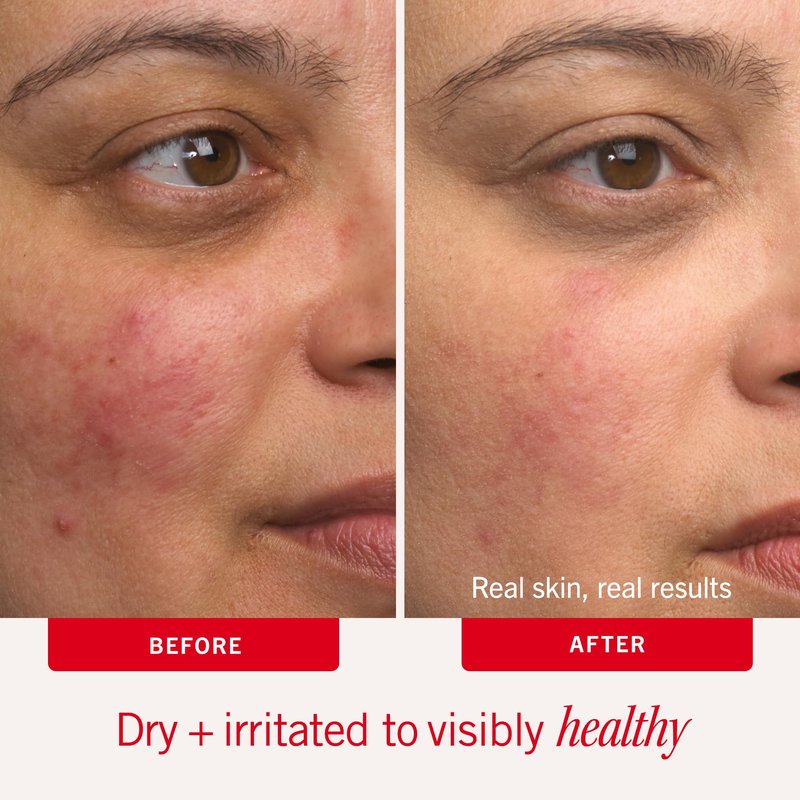 First Aid Beauty - Ultra Repair Cream - Intense Hydration Face & Body Moisturizer - Whipped Colloidal Oatmeal Clinically Proven to Strengthen Skin Barrier in 7 Days - Helps Relieve Eczema, 8 oz