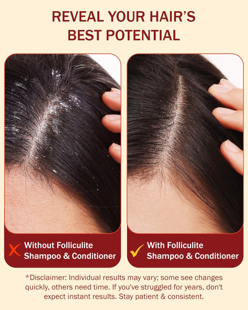Folliculitis Treatment Shampoo and Conditioner with 3% BHA, Salicylic Acid, Aloe Vera & Tea Tree Oil - Anti Itch Shampoo for women & men with Flaky Scalp Treatment Acne, Made in USA by e70, 8 fl oz